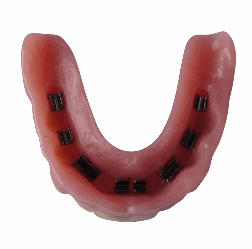 Bovenprothese op implantaten (steg) - Van Loenen Tandtechniek