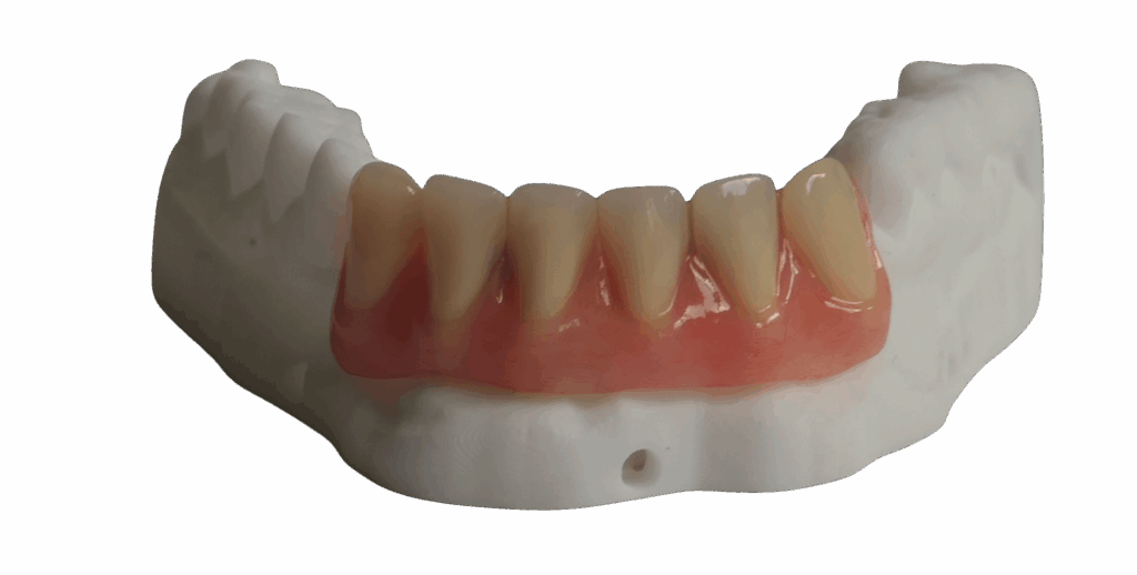 Gedeeltelijke prothese op steg met drukknoppen 2 - Edited